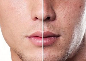 Cách làm mờ vết nám và tàn nhang cho nam