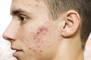 Cách làm mờ vết sẹo thâm cho nam