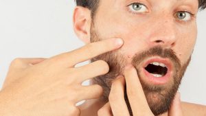 Trị mụn nội tiết ở nam: Phương pháp hiệu quả