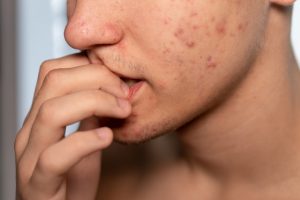 Trị sẹo thâm do mụn ở nam có phương pháp nào?